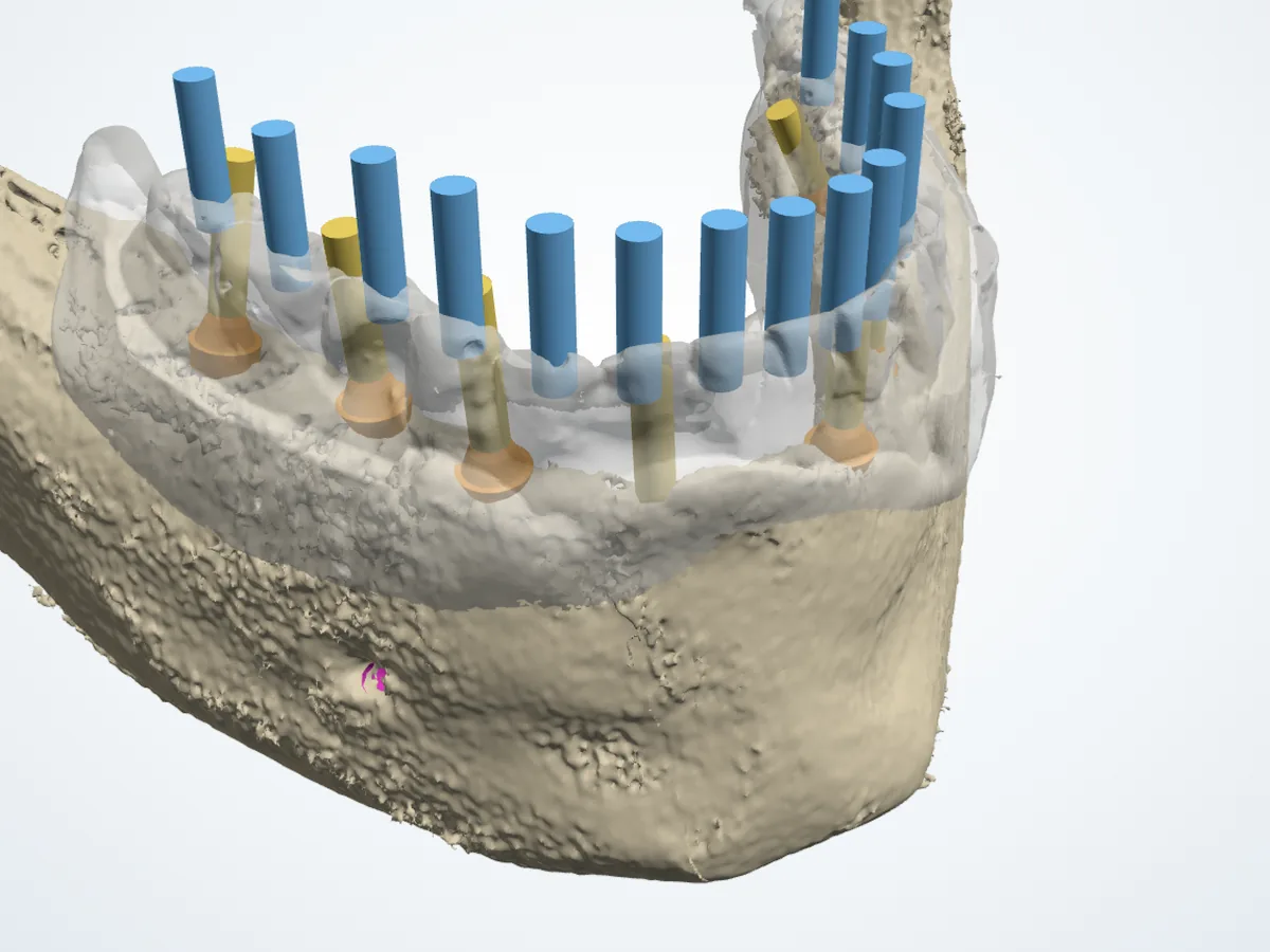 ayGuide Yazılım: 7 implantlı alt çene planı, implantlar, abutmentlar ve vida çıkışları