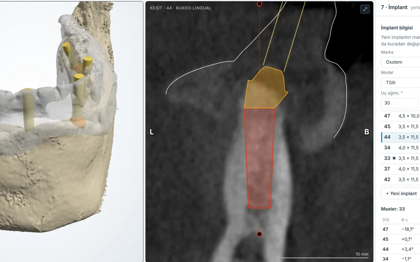 Kesit görünümünde implant ve canlı mesafe ölçümleri