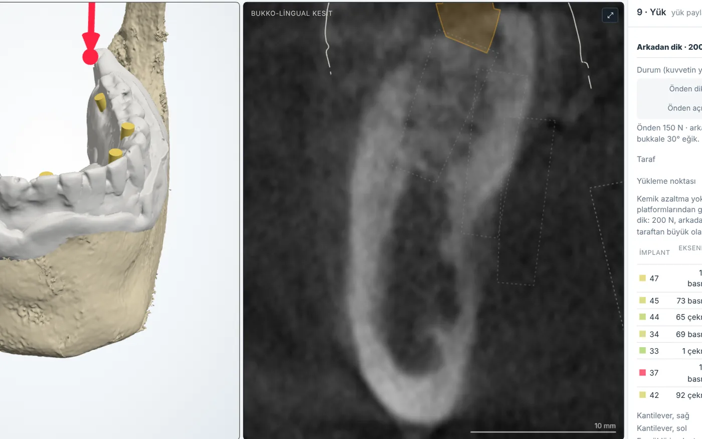 Yük paylaşımı analizinde implantlara düşen kuvvetin renk haritası