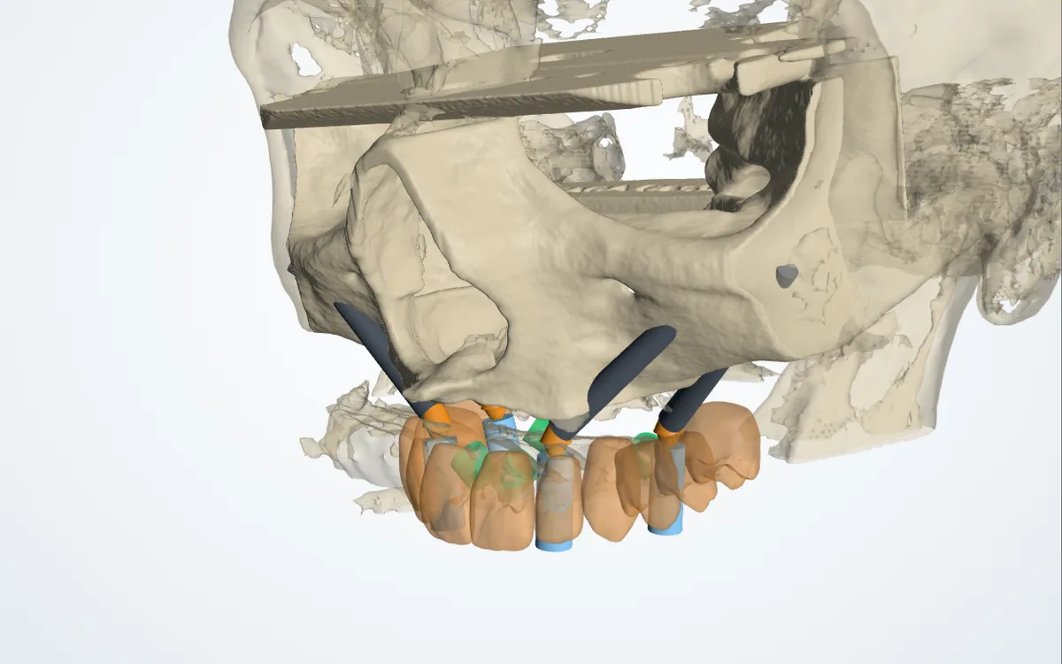 Zigomatik implant planlama ekranı